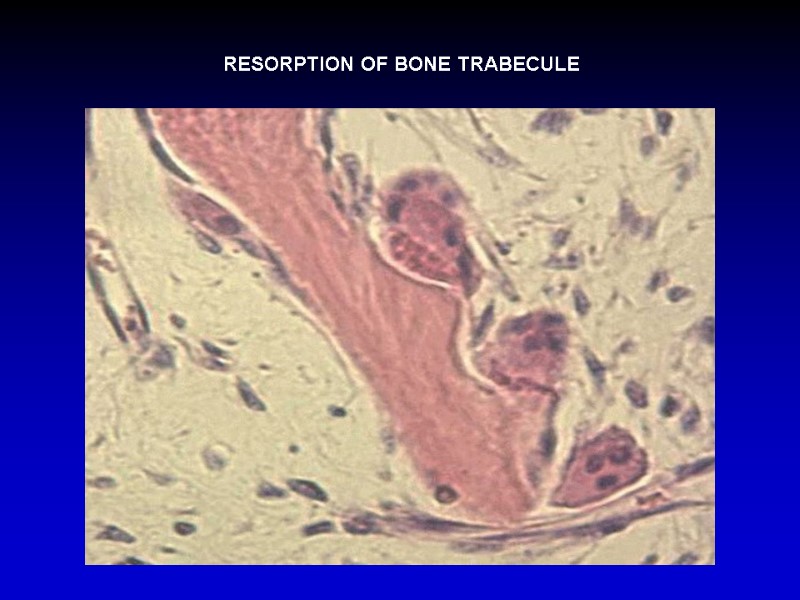 RESORPTION OF BONE TRABECULE